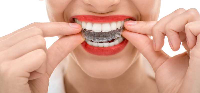 Woman inserting a clear casing over her teeth.