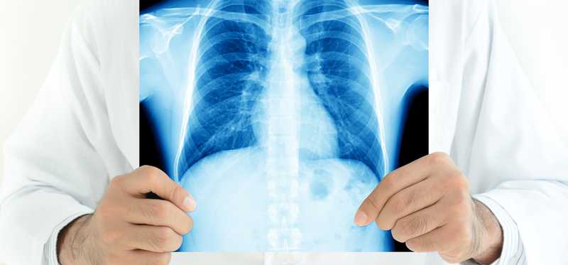 Doctor holding chest x-ray in front of him.